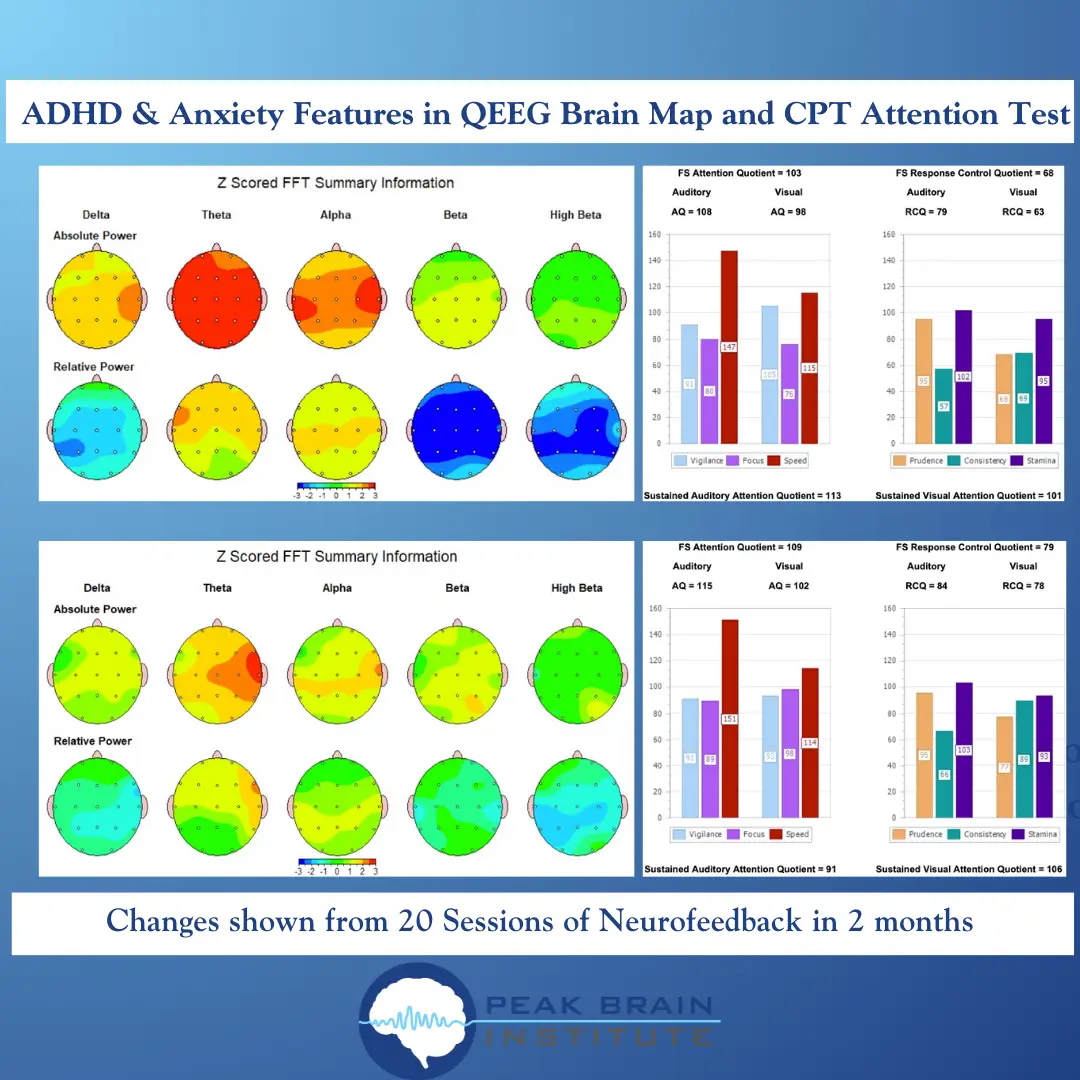 ADHD and anxiety features in QEEG brain map and CPT attention test; changes after 20 sessions of neurofeedback in ~2 months